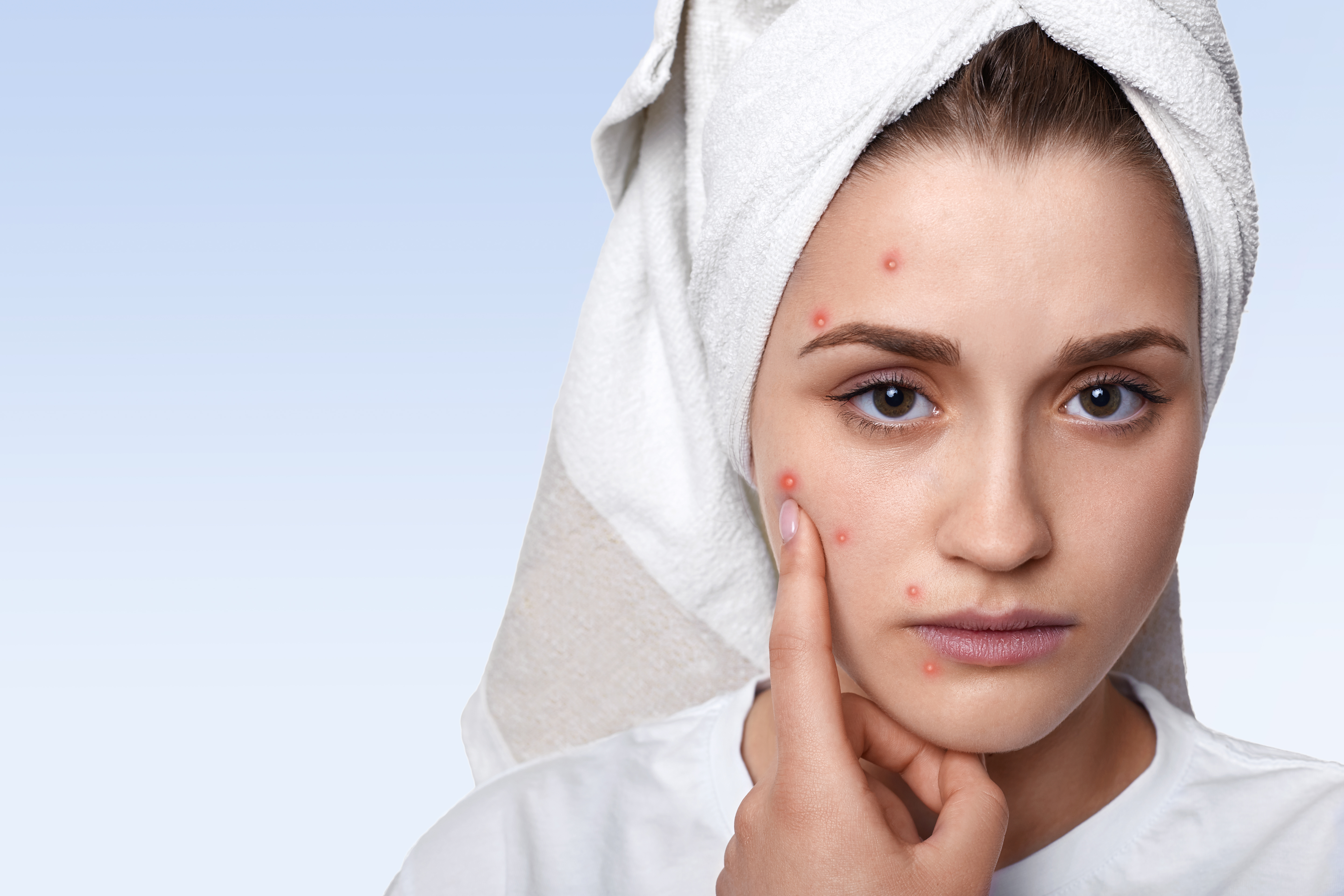 Soorten acne herkennen: van mee-eters tot onderhuidse ontstekingen