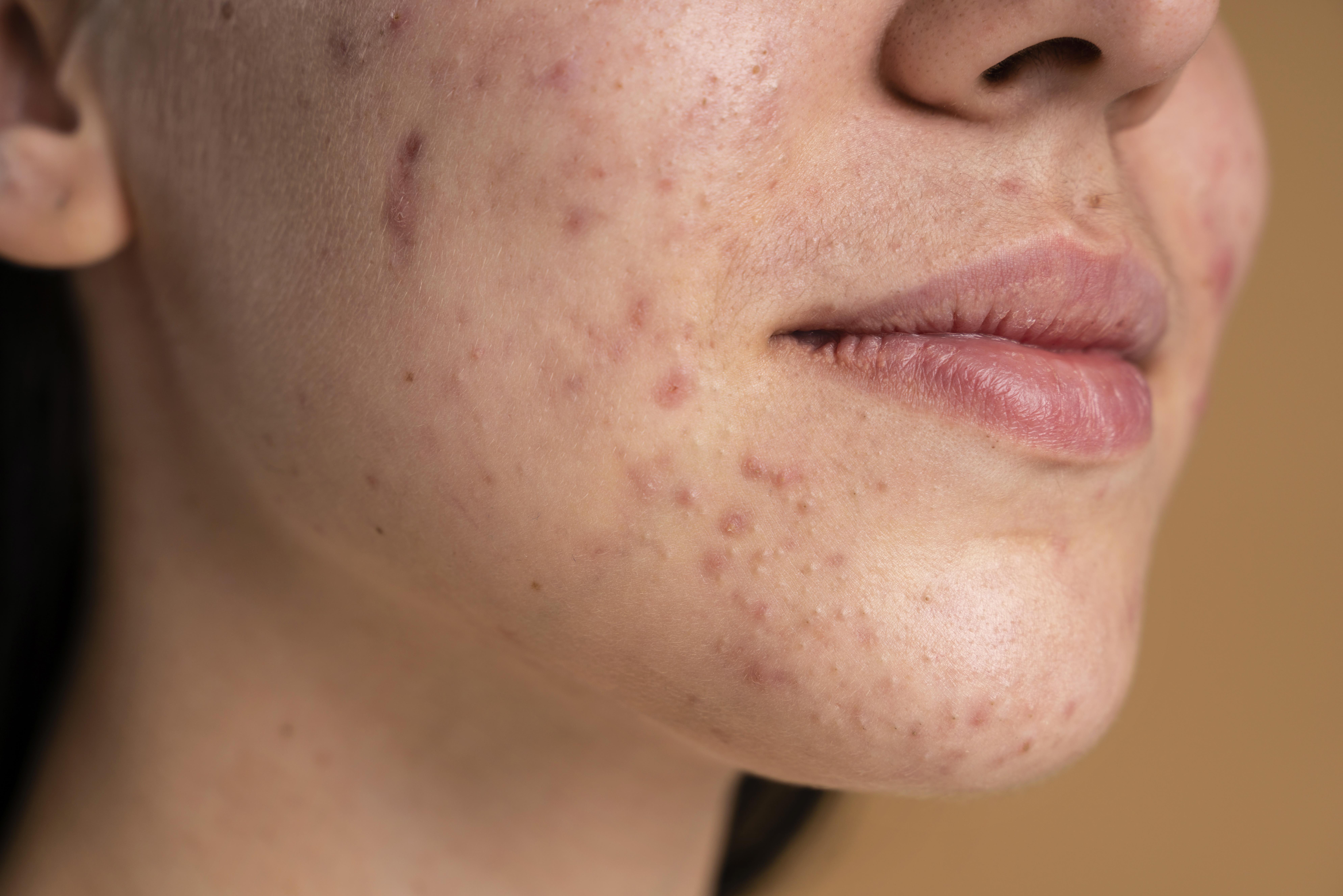 Skincare tips en advies bij acne