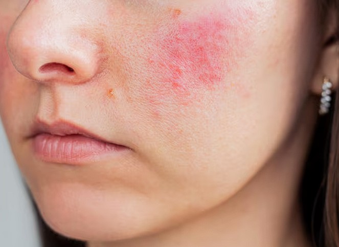 Gevoelige huid of allergische reactie: wat is het verschil?